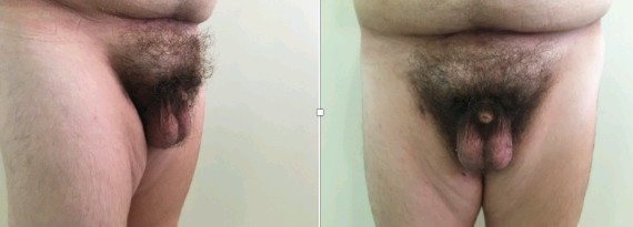 Adulto com pênis embutido